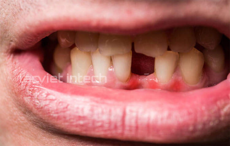 Ưu nhược điểm khi trồng răng bằng phương pháp cấy ghép implant 1