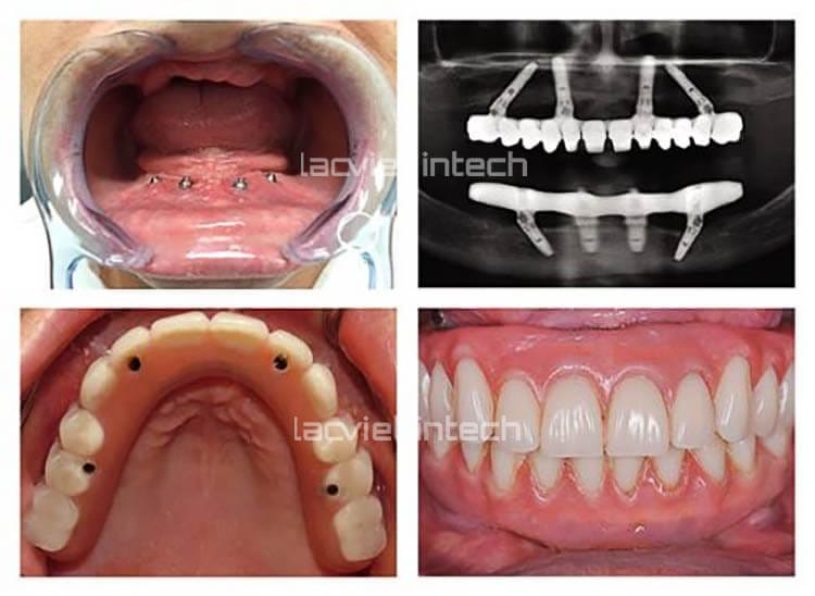 Implant all-on-4 mang lại nhiều ưu điểm nổi bật nổi trội