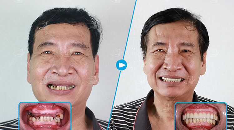Cấy chân răng sinh học là gì?