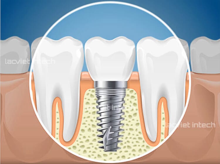 trong-rang-implant-khi-mat-rang-cam