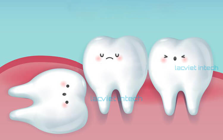 Chi phí nhổ răng khôn có bảo hiểm bao nhiêu?