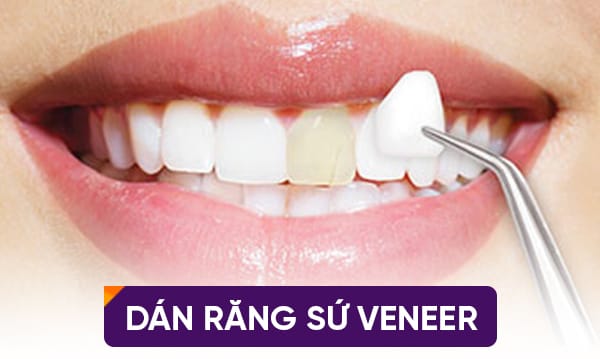 Dán răng sứ Veneer bền không