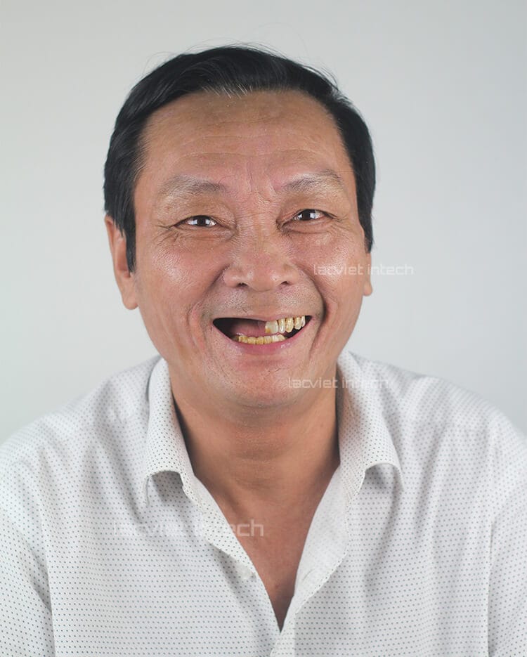 Mất răng và những hậu quả khôn lường 1