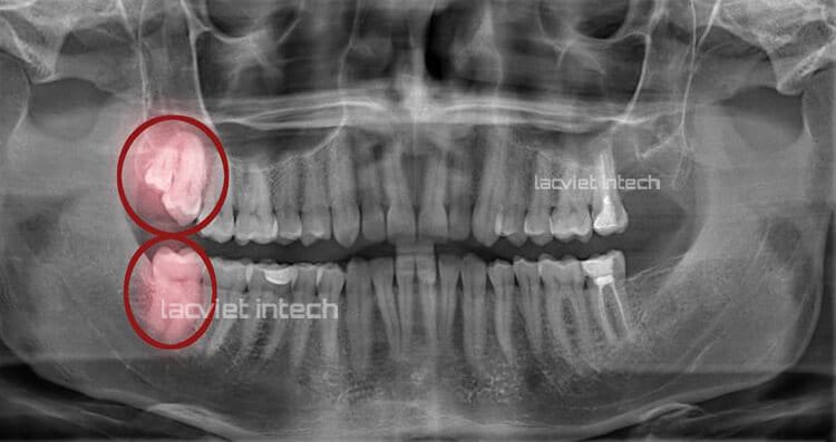 Răng khôn mọc ở đâu? Mọc như thế nào? Mọc răng khôn trong bao lâu?