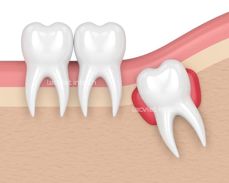 Răng khôn mọc ở đâu? Mọc như thế nào? Mọc răng khôn trong bao lâu?