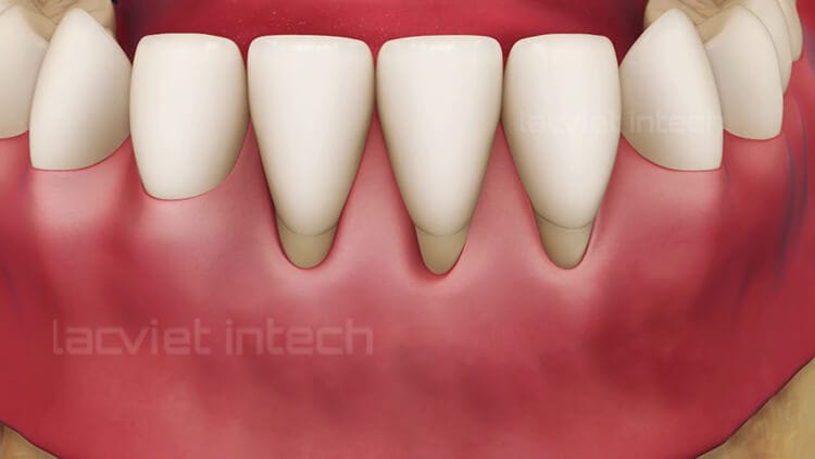 Mất răng và những hậu quả khôn lường 2