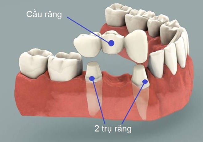 3 Cách lựa chọn để thay thế khi bị mất răng
