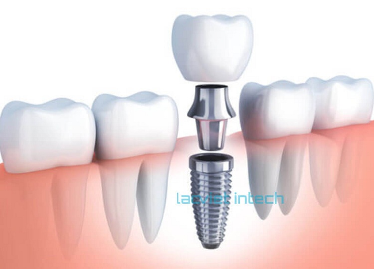 5 Bước quy trình trồng răng Implant và phục hồi