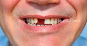 Bị gãy răng cửa có ảnh hưởng đến thẩm mỹ và chức năng ăn nhai