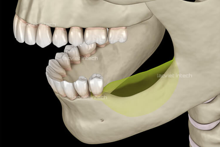 Tiêu xương vùng mất răng