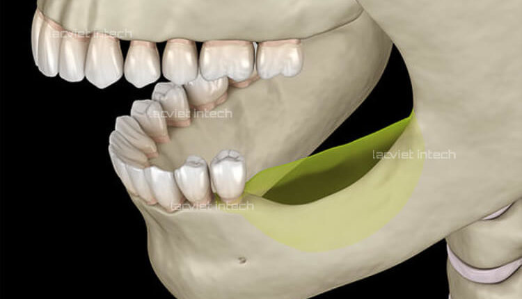 Mất răng không khắc phục sớm làm tiêu xương hàm