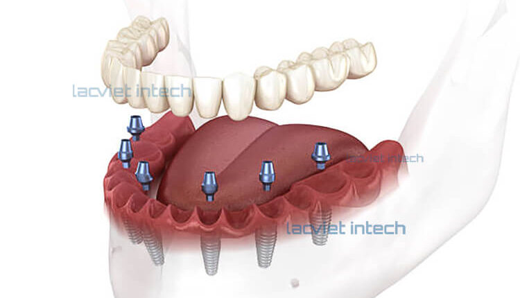 8 Ưu điểm của trồng răng Implant all on 6 khôi phục thẩm mỹ