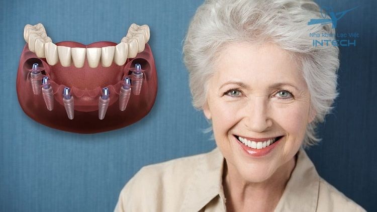 Những ưu điểm của trồng răng implant all on 6