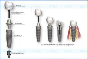 Hình ảnh mô tả cấu tạo của răng implant 