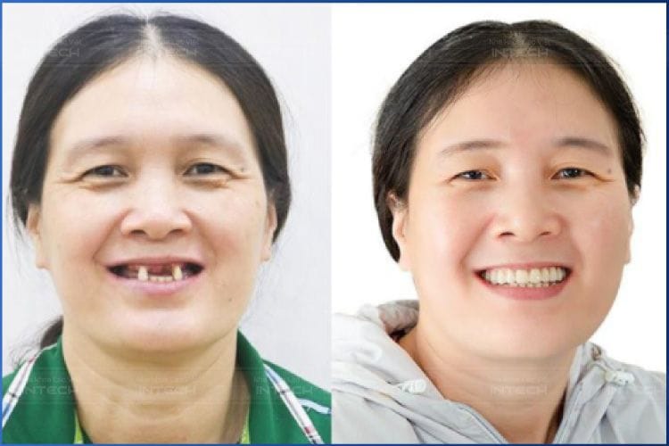 khách hàng trồng răng Implant