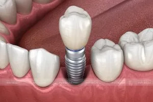 trồng răng implant