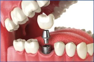 Loại răng sứ sử dụng cũng ảnh hưởng đến chi phí trồng răng implant