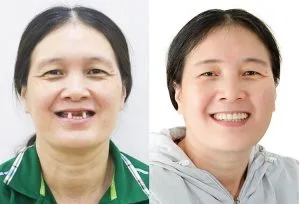 Nha khoa Lạc Việt Intech - Trung tâm trồng răng Implant chuyên sâu - hành trình cấy ghép implant