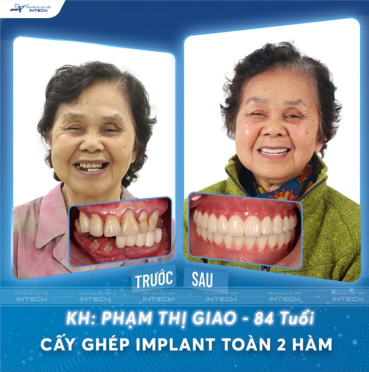 Bác Phạm Phi Giao - 84 tuổi mất khá nhiều răng cả hai hàm. Sau phục hình trồng răng Implant tại Lạc Việt Intech đã giúp bác có hàm răng mới, đáp ứng ăn nhai cũng như thẩm mỹ.