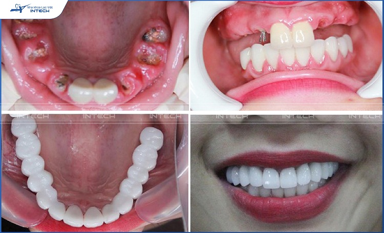 Một trường hợp đa sâu răng, các chân răng mục nát được nhổ bỏ và thay thế bằng implant.