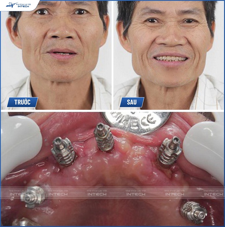 Khách hàng bị mất răng toàn hàm được đặt 5 trụ Implant. Giờ đây vị khách hàng này có thể ăn nhai ổn định, thoải mái.