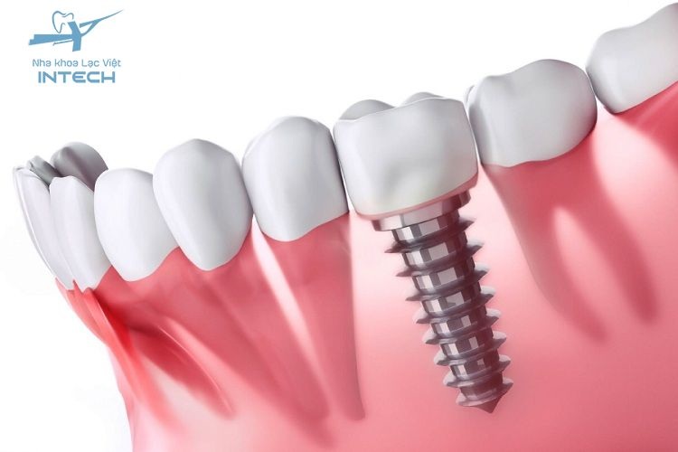 Trồng răng hàm bằng cấy ghép Implant