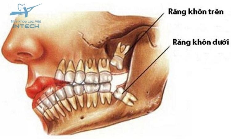 Răng khôn nhiễm trùng có thể gây sưng góc hàm