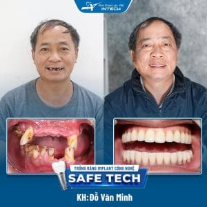  Khách hàng Đỗ Văn Minh cấy ghép Implant All-On-6 2 hàm