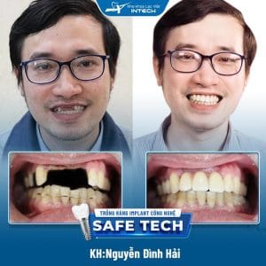 Khách hàng Nguyễn Đình Hải sử dụng dịch vụ trồng răng Implant Safe - Tech