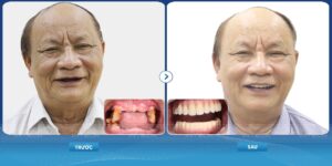 Cải thiện thẩm mỹ đáng kể nhờ trồng răng implant toàn hàm