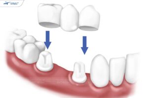 Phương pháp trồng răng sứ bắt cầu phục hình răng mất
