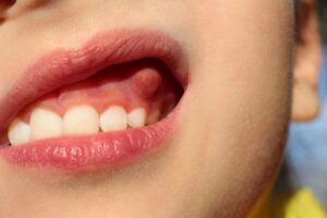 Bạn đang gặp khó khăn với bệnh áp xe răng và không biết cách điều trị sao cho hiệu quả? Xem hình ảnh liên quan để có thêm thông tin và cách điều trị áp xe răng tốt nhất.