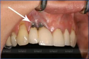 Nha khoa Lạc Việt Intech - Trung tâm trồng răng Implant chuyên sâu - biến chứng trồng răng implant giá rẻ