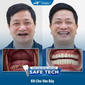 Chú Chu Văn Bảy trước và sau khi trồng răng implant.
