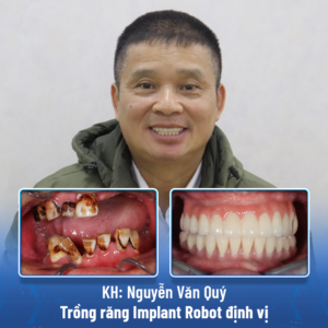 Khách hàng Nguyễn Văn Quý trải nghiệm trồng răng Implant bằng robot định vị.