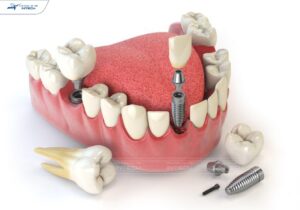 Trồng răng số 6 bằng trụ implant