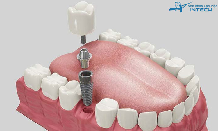  Trồng răng Implant chỉ phục hình tại vị trí răng mất, không xâm lấn răng bên cạnh