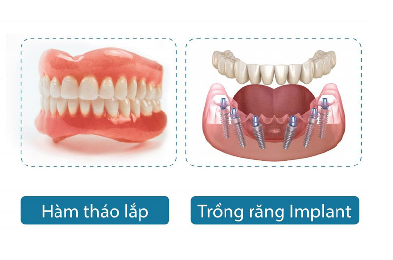 So sánh phương pháp làm hàm giả tháo lắp và trồng răng implant toàn hàm