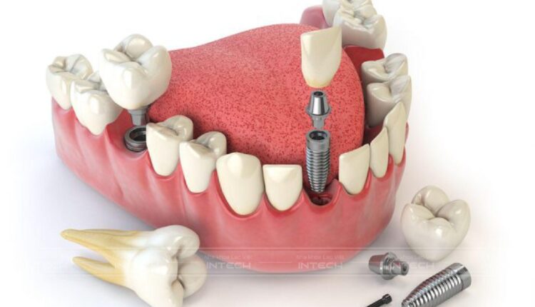 Trồng răng implant là giải pháp phục hình răng mất tối ưu nhất hiện nay