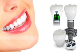 Trồng răng Implant có tính thẩm mỹ cao