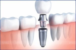 Nếu không được chăm sóc đúng cách, trụ implant có thể bị đào thải