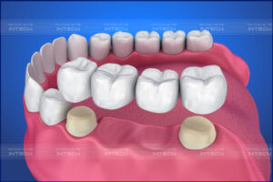 Làm răng sứ bắc cầu có nguy cơ bị mất răng thật 