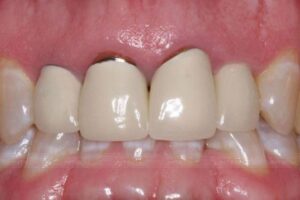 Răng sứ kim loại có thể gây đen viền nướu, khiến cho răng mất thẩm mỹ