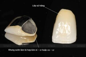 Răng sứ kim loại thường với khung sườn được cấu tạo từ hợp kim
