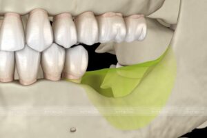 Trồng răng Implant giúp ngăn chặn tình trạng tiêu xương hàm