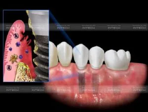 Nha khoa Lạc Việt Intech - Trung tâm trồng răng Implant chuyên sâu - implant kém chất lượng