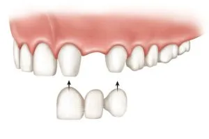 Chụp răng sứ, cầu răng sứ