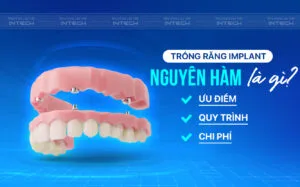 Trồng Răng Implant Nguyên Hàm Là Gì? Ưu Điểm, Quy Trình Và Chi Phí
