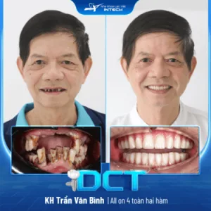 Nha khoa Lạc Việt - Trung tâm trồng răng Implant chuyên sâu - khách hàng trồng răng implant toàn hai hàm