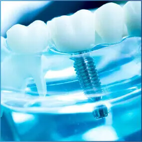 Nha khoa Lạc Việt - Giải pháp cấy chân răng sinh học